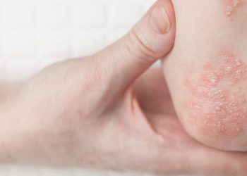 novo-remedio-via-oral-para-psoriase-oferece-alternativa-mais-pratica-e-eficaz