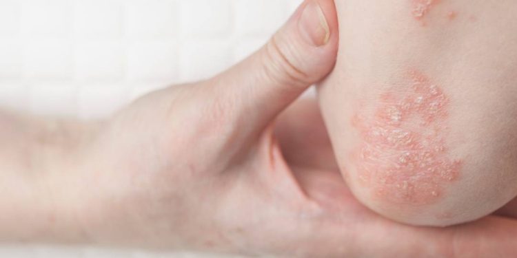 novo-remedio-via-oral-para-psoriase-oferece-alternativa-mais-pratica-e-eficaz