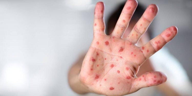 sao-paulo-confirma-primeiro-caso-de-sarampo-de-2025