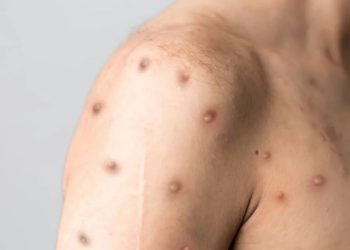 regiao-norte-do-brasil-registra-casos-de-mpox