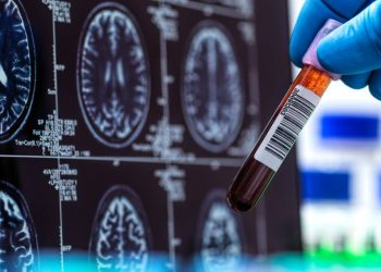 exame-brasileiro-tem-precisao-de-ate-94%-no-diagnostico-do-alzheimer
