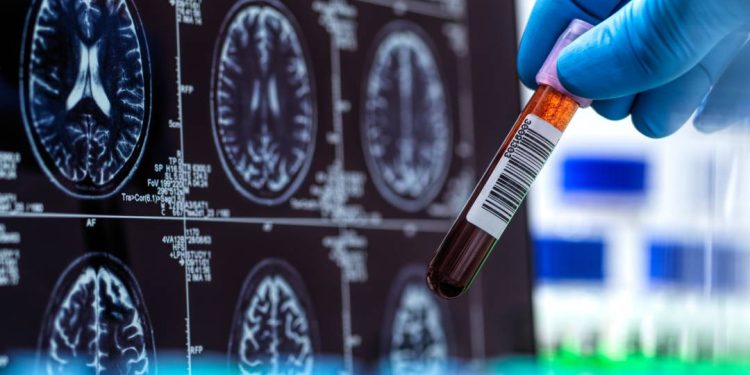 exame-brasileiro-tem-precisao-de-ate-94%-no-diagnostico-do-alzheimer
