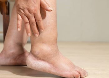 lipedema,-uma-doenca-que-se-camufla-e-se-confunde-com-obesidade