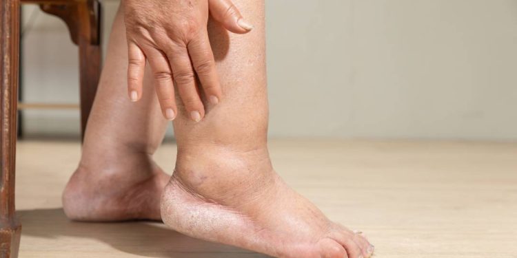 lipedema,-uma-doenca-que-se-camufla-e-se-confunde-com-obesidade