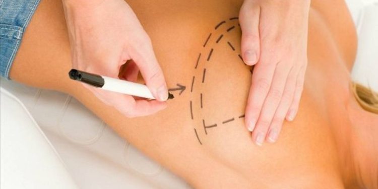 sus-amplia-acesso-a-cirurgia-de-reconstrucao-mamaria-para-alem-dos-casos-de-cancer