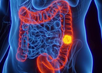 por-que-o-cancer-de-intestino-em-jovens-tornou-se-preocupacao-global