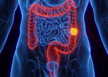 ancestralidade-genetica-pode-influenciar-risco-de-cancer-colorretal,-sugere-estudo-brasileiro