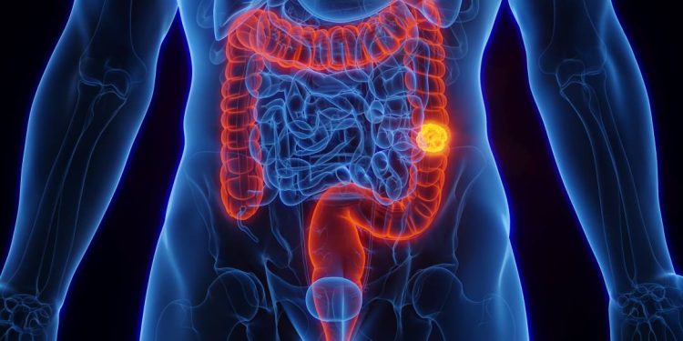 ancestralidade-genetica-pode-influenciar-risco-de-cancer-colorretal,-sugere-estudo-brasileiro