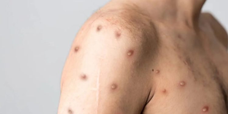 mpox:-entenda-infeccao-com-novo-caso-registrado-no-brasil-e-quais-os-riscos-apos-carnaval