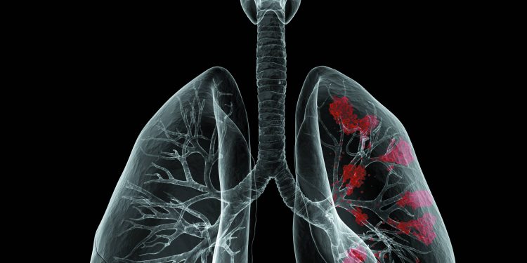 o-cancer-de-pulmao-esta-entre-nos-–-e-ainda-nao-olhamos-o-suficiente-para-ele
