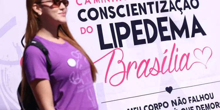 Lipedema: doença crônica vai além da questão estética